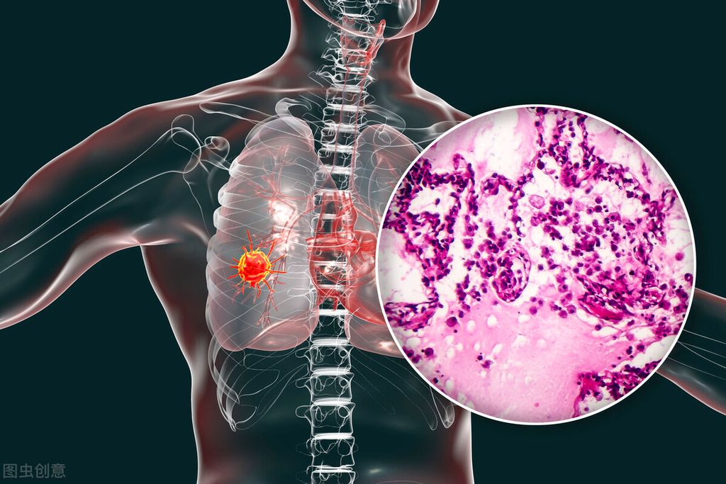 Capmatinib: Sự Đột Phá Trong Điều Trị Ung Thư Phổi Không Tế Bào Nhỏ (NSCLS) có Đột Biến Gen MET