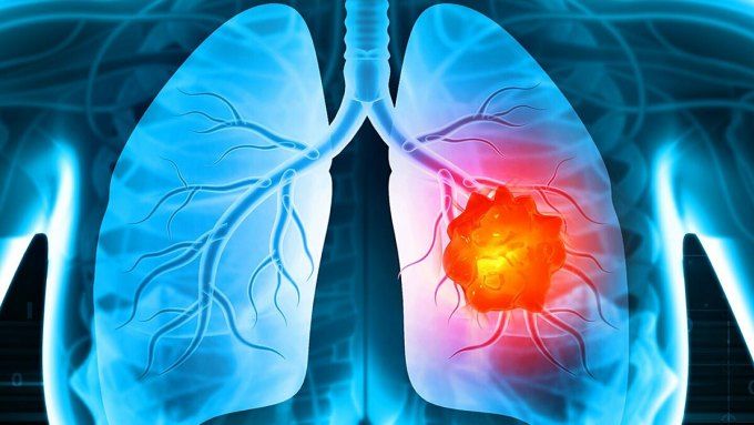 Nghiên Cứu Mới Năm 2024: Hút Thuốc Lá Thụ Động Làm Tăng Nguy Cơ Ung Thư Phổi!
