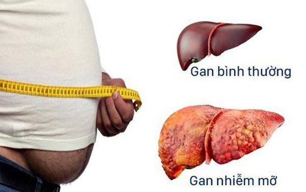 RESMETIROM: Thuốc Đầu Tiên Trên Thế Giới Điều Trị Gan Nhiễm Mỡ Không Do Rượu