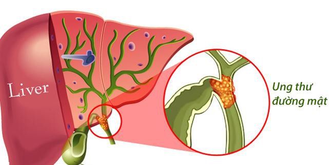 Phê Duyệt Lịch Sử: Pemigatinib Trở Thành Vũ Khí Mới Trong Cuộc Chiến Chống Ung Thư Đường Mật