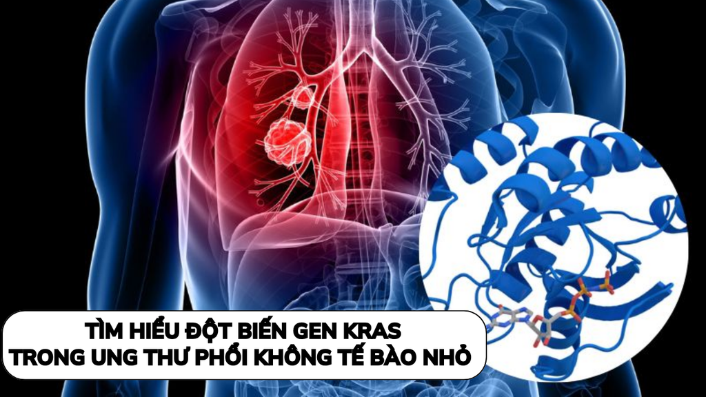 Khám phá hành trình 40 năm, tìm hiểu đột biến gen KRAS trong ung thư phổi không tế bào nhỏ !