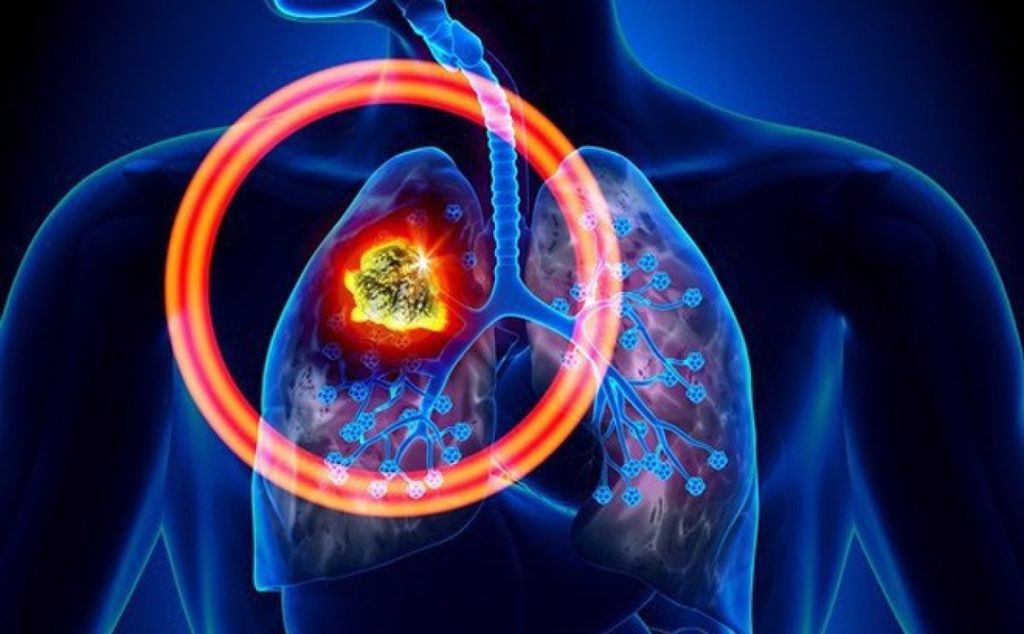 Cập Nhật Phác Đồ Điều Trị Ung Thư Phổi Giai Đoạn IV không Tế Bào Nhỏ có Đột Biến Gen Âm Tính: Hướng Dẫn từ ASCO 2023
