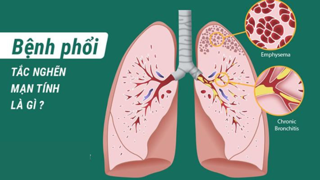 BỆNH PHỔI TẮC NGHẼN MẠN TÍNH: DẤU HIỆU CẦN PHÁT HIỆN VÀ ĐIỀU TRỊ SỚM