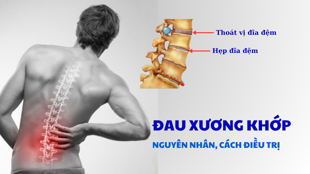 BỆNH ĐAU LƯNG Ở NGƯỜI LỚN: NGUYÊN NHÂN, CÁCH CHUẨN ĐOÁN VÀ ĐIỀU TRỊ