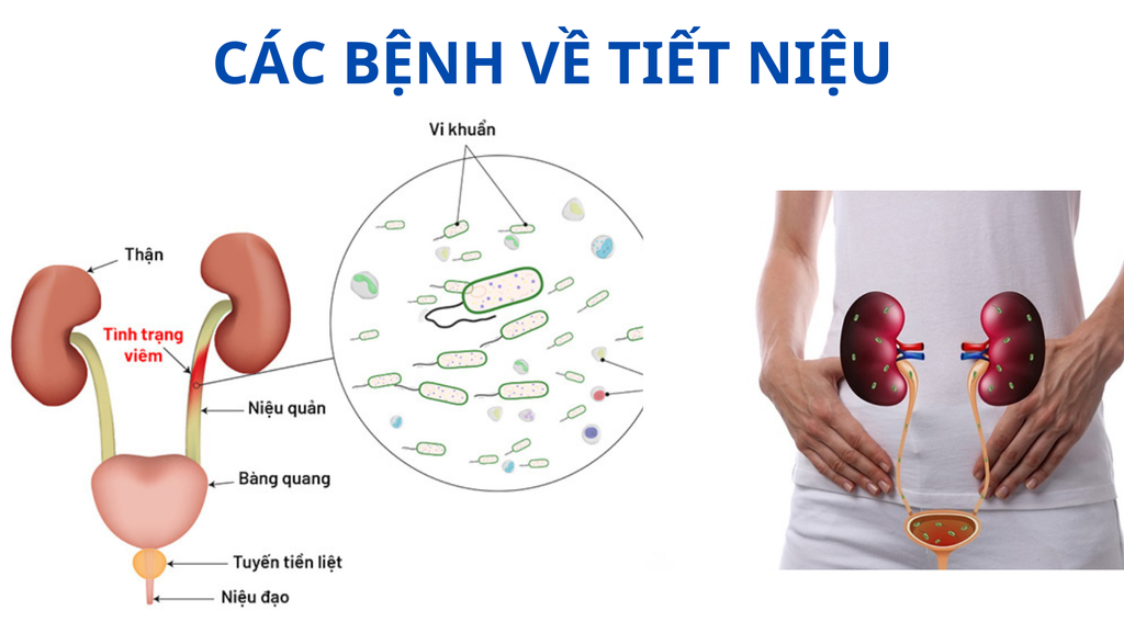 BỆNH TIẾT NIỆU: CÁC BỆNH THƯỜNG GẶP NHẤT VÀ CÁCH PHÒNG NGỪA