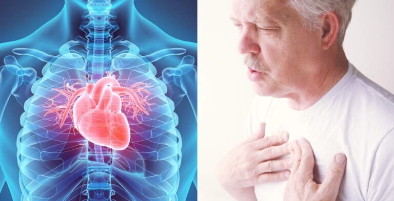 VIÊM CƠ TIM: NGUYÊN NHÂN, TRIỆU CHỨNG, CHẨN ĐOÁN VÀ ĐIỀU TRỊ