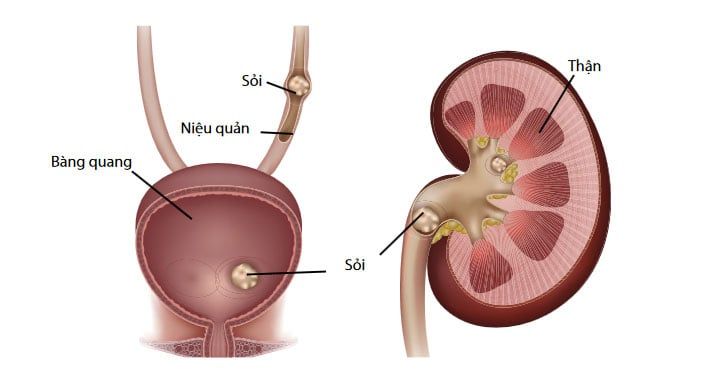 NGUYÊN NHÂN GÂY SỎI THẬN?