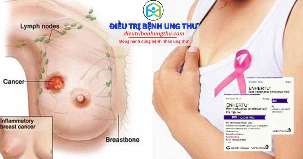 Khám Phá ENHERTU: Tại Sao Thuốc Này Được Kỳ Vọng Là Phương Pháp Điều Trị Mới Cho Ung Thư Vú HER2+