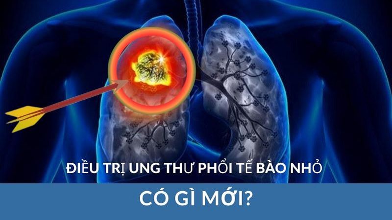 Tarlatamab: Kháng Thể Đặc Hiệu Kép Đầu Tiên Trên Thế Giới Trong Điều Trị Ung Thư Phổi Tế Bào Nhỏ