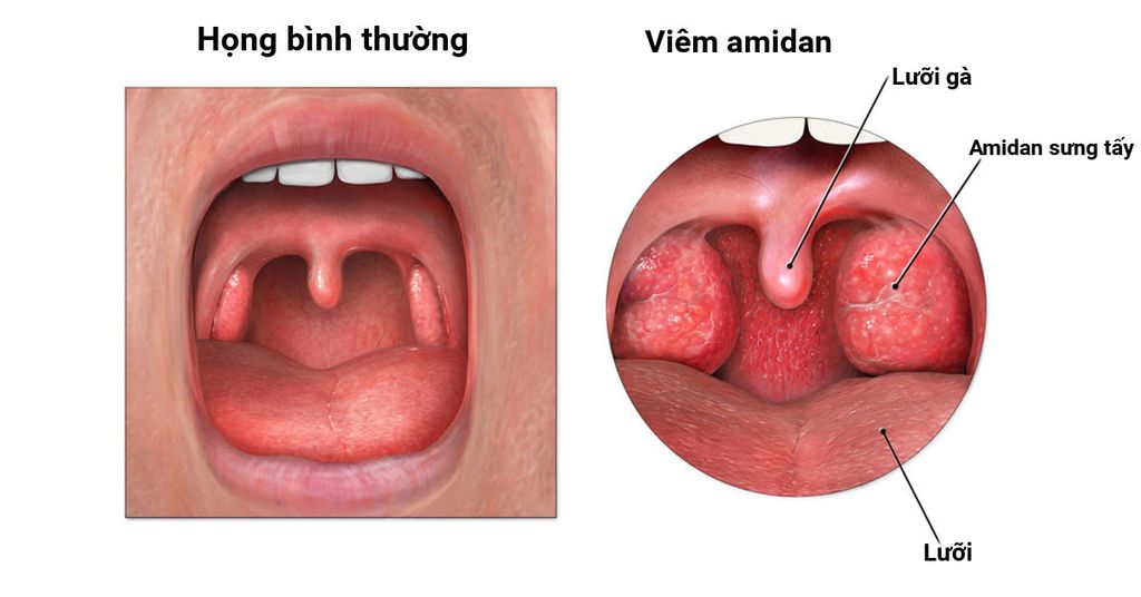 Liệu ba mẹ đã hiểu rõ về bệnh Viêm Amidam để còn biết cách phòng tránh ?