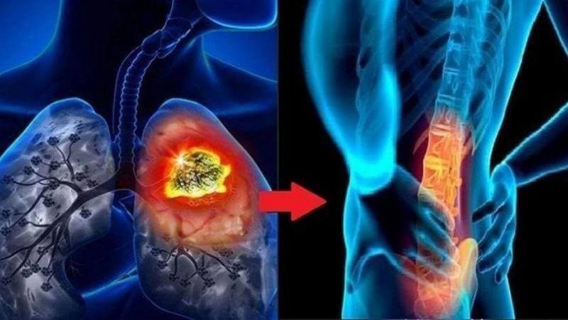 Bảo Vệ Xương Trong Điều Trị Ung Thư Phổi Di Căn Xương: Denosumab vs Axit Zoledronic
