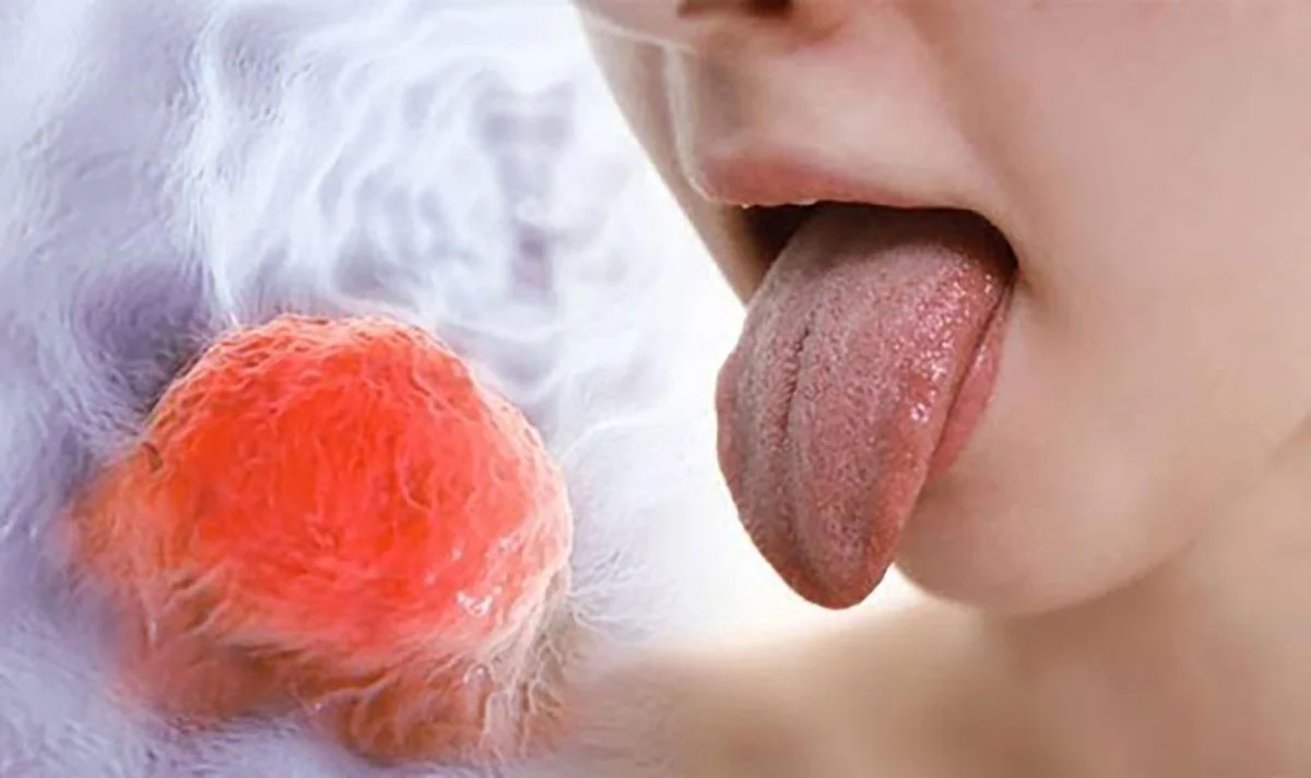 Ung thư lưỡi: nguyên nhân, triệu chứng và cách điều trị