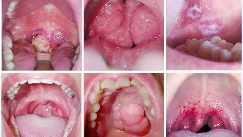 Ung thư miệng: nguyên nhân, triệu chứng và cách điều trị