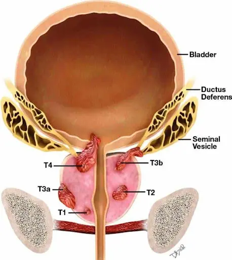 Ung thư tuyến tiền liệt: nguyên nhân, triệu chứng và cách điều trị