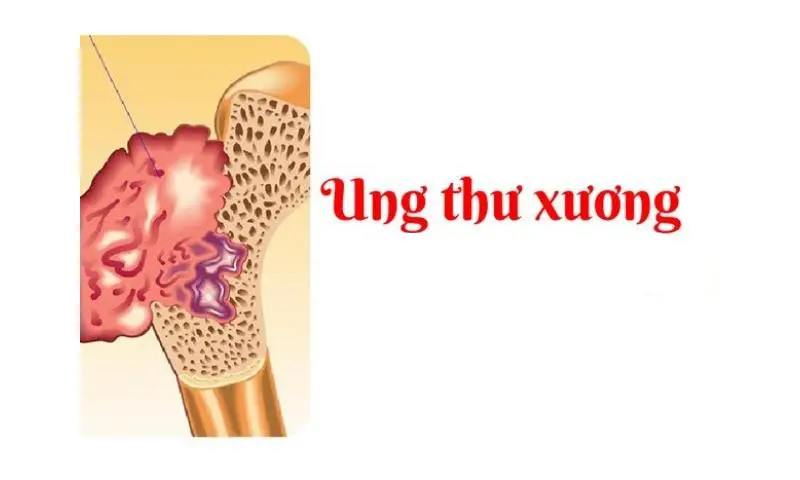 Ung thư xương: nguyên nhân, triệu chứng và cách điều trị
