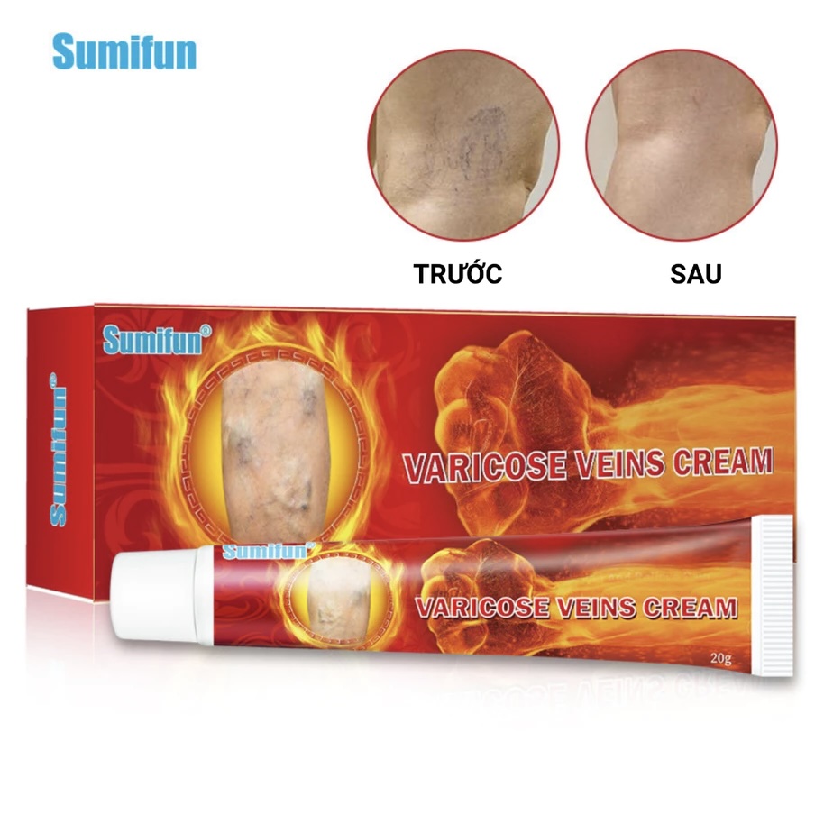 Kem bôi suy giãn tĩnh mạch Varicose Veins Cream